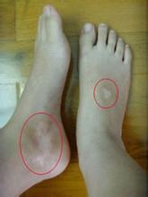 脚上出现白斑的影响有哪些