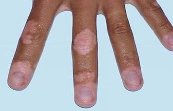 如何护理好手部皮肤上的白斑
